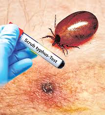 స్క్రబ్‌ టైఫస్‌